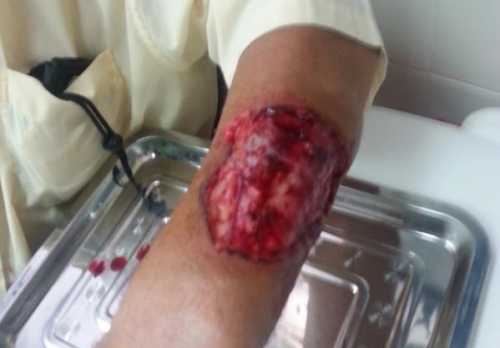 Este es el brazo de Mario Hernández tras el brutal ataque del perro, que solo fue de unos segundos.