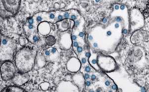 DC/Hannah A Bullock/Azaibi Tami Una imagen microscópica muestra la infección del coronavirus (en azul) del primer paciente descubierto en Estados Unidos.
