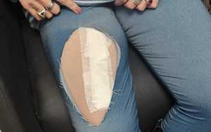Una de las varias heridas que sufrió, en este caso en su pierna derecha, en el intento de los agresores de rasgarle la ropa.