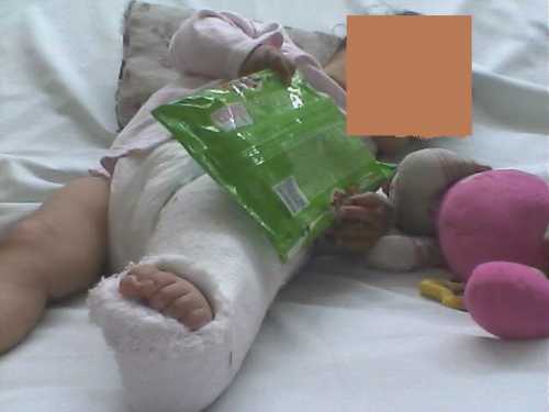 La inocente pequeña, enyesada, durante su internación en el hospital Pereyra Rossell